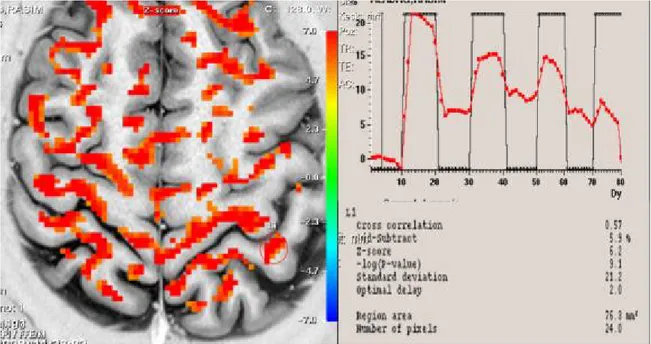 Şekil 13.  Olgu 4’ün  sahte TENS uygulamasından önce yapılan fMRG’sinde kontralateral  S1 (kırmızı halka)’deki aktiviteyi gösteren fMRG kesiti, sinyal eğrisi ve Z skoru değeri 