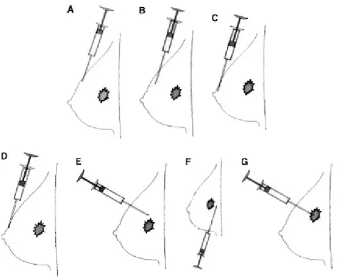 Şekil 5: Meme dokusuna sentinel lenf nodu tespiti amacıyla yapılan enjeksiyon teknikleri