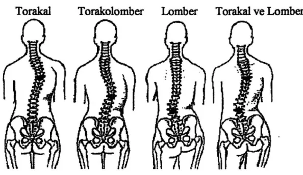 Şekil 5: Skolyozda eğrilik tipleri