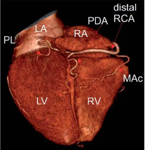 Şekil 6: RCA’ nın distal dalları. LA: sol atrium, RA: sağ atrium, LV: sol ventrikül, RV:  sağ  ventrikül,  MAc:  akut  marjinal  dal,  PL:  posterolateral  dal,  PDA:  posterior  inen  arter(22).