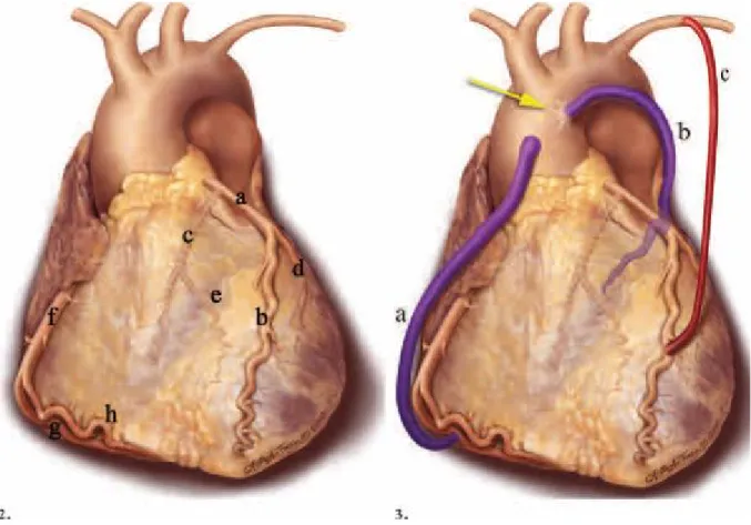 Şekil  9:  Koroner  bypass  greftlerin  şematik  çizimi.  3  no’lu  şekilde  a:  Aort  ile  PDA  arasına  uygulanmış  safen  venöz  greft(SVG),  b:  Proksimal  anastamozun  aortik  konektör cihaz(sarı ok) ile yapıldığı bir SVG, c : Distal LAD’ye anastamoze
