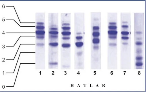 Şekil 4. Transferrin izoform paternleri. Hat 1 ve 6 normal patern, hat 2 ve 3 tip 1 patern, hat 4 ve 5 tip 