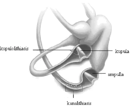 Şekil 3. Kupulolithiasis ve kanalithiasis (4) 