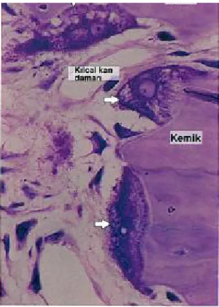 Şekil 12: Kemik dokusunu sindiren üç osteoklast (oklar)