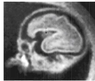 Şekil  1:  24-25.  haftalar  arasında  fetusa  ait  patolojik  kesit  ve  MR  kesiti,  sylvian  fissürün  sınırlarını oluşturan lateral sulkus (1) 
