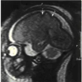 Şekil 2: 24-25. haftalarda fetusa ait patolojik kesit ve 26. haftada fetusa ait MR kesiti Santral  sulkus (1) ve postsantral sulkus (2) 