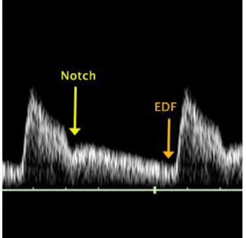 Şekil  7:  Uterin  arterde  erken  diastolik  çentik  (Notch)  ve  diastol  sonu  akım  kaybı  (EDF) 