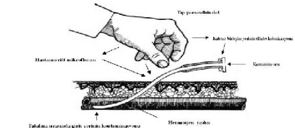 Şekil 4: Mikroorganizmaların damar-içi katetere giriş şekli 