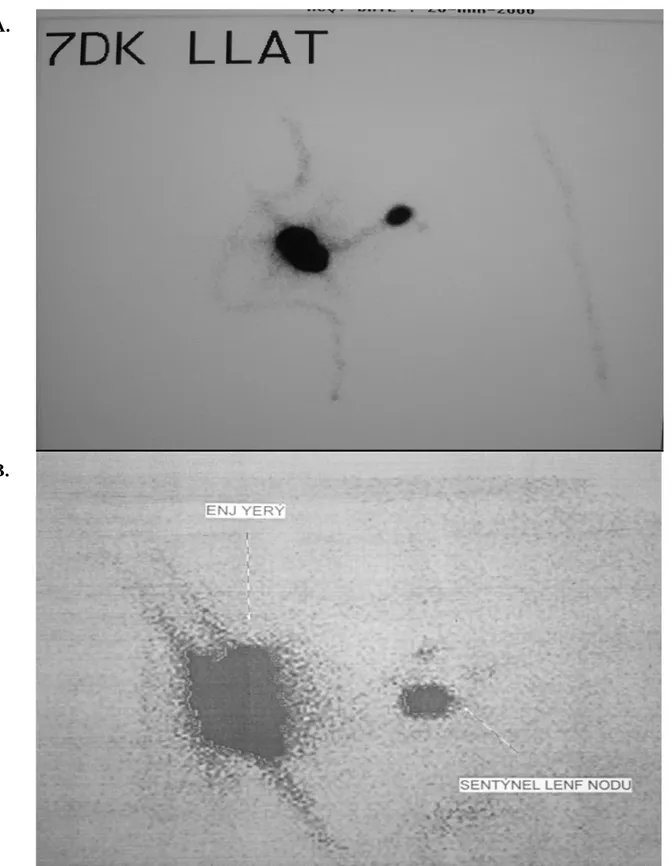 Şekil 6 A-B. Lenfosintigrafi sonrası gama kamera çekim görüntüsü 