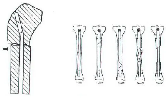 Şekil 9. Kırık tipine göre intramedüller çivi vidalama (29) 
