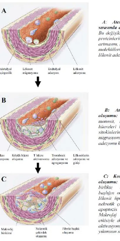 Şekil 1- Aterosklerotik lezyon oluşumu sırasında oluşan ilk değişikliklerden komplike plak 