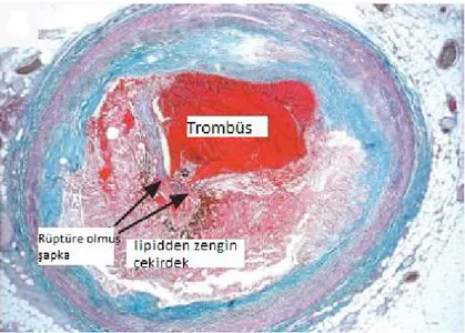 Şekil 2- Plak rüptürü sonucu trombüs gelişimi  1.2. KORONER KALP HASTALIĞI 