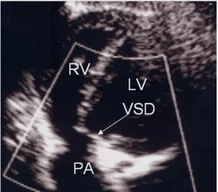 Şekil 2.2.6. Transtorasik  2-B  EKO’da  subkostal  kesitte  doubly  committed  juksta-arteryel  VSD’nin görünümü