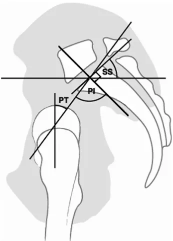 Şekil 3. Pelvik insidans parametreleri (PI:pelvik insidans; PT:pelvik tilt; SS:sakral slope) 