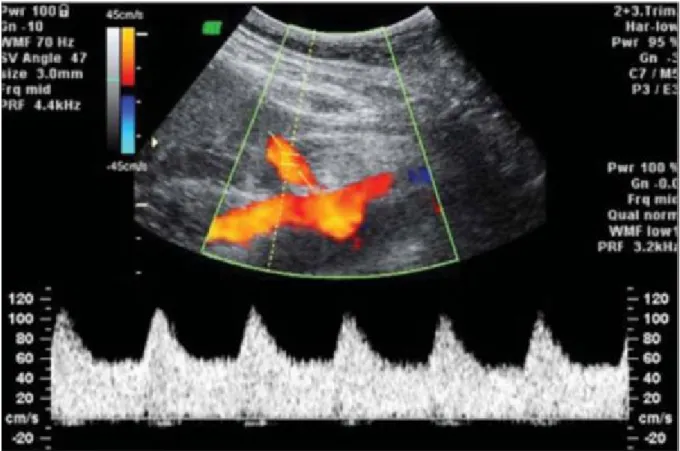 Şekil 4.2 Uterin arter doppler dalga formunun normal görüntüsü 