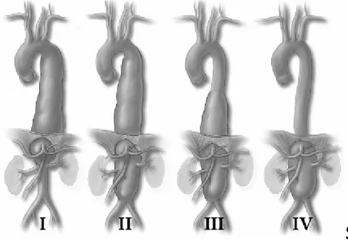 Şekil 3: Torakoabdominal aort anevrizmalarında Crawford sınıflaması 