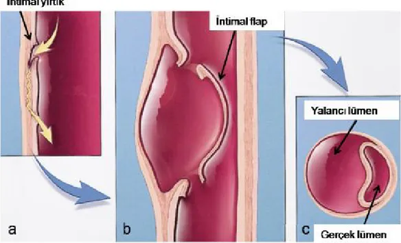 Şekil  8:  Aort  disseksiyonunun  şematik  gösterimi:  İntima  tabakasındaki  giriş  ve  çıkış 