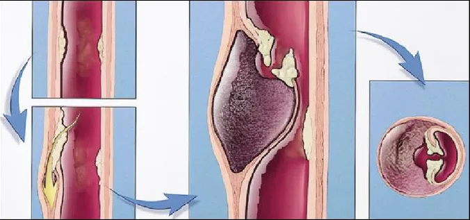 Şekil  11:  Aortun  intima  tabakasındaki  aterom  plağının  erezyonu  sonucu  plakta  media 