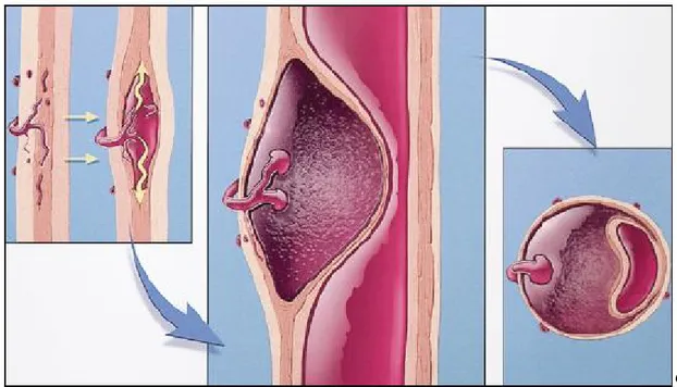 Şekil  12:  Aortun  media  tabakasını  besleyen  vasa  vasorumlardaki  kanama  sonucu 