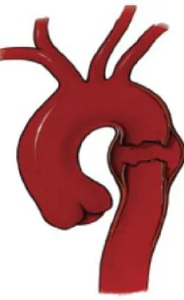 Şekil 13: İnen aort düzeyindeki travmatik aort yırtığı 