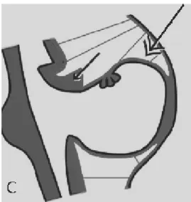 Şekil 14: DWC şematik çizimi (26), farklı derecelerde vermis hipoplazisi, dilate rombensefalik  vezikül nedeniyle vermisin elevasyonu, çeşitli derecedelerde foramina Luschka ve Magendinin  fenestrasyonu 