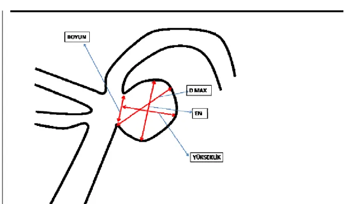 Şekil 11:Anevrizma morfolojik parametreleri  