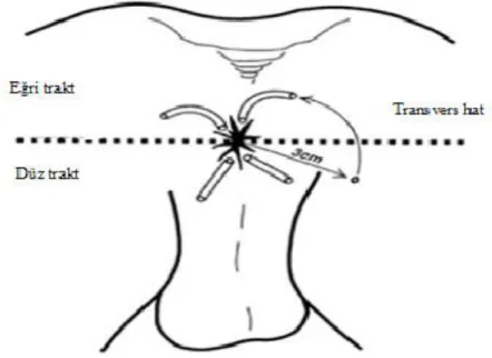 Şekil 3:Goodsall - Sallmon kuralı (The ASCRS text book of colon and rectum surgery) 