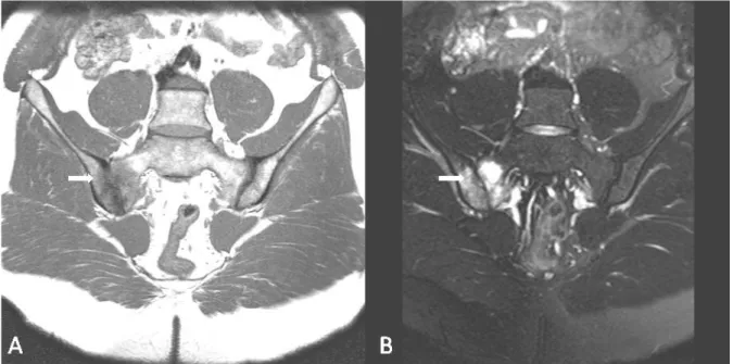 Şekil 1. Sakroiliak eklem magnetik rezonans görüntülemede sağ sakroiliak eklem iliak  ve sakral kemiklerde eklem komşuluğunda kemik iliği ödemi ile uyumlu şekilde; T1 ağırlıklı  kesitlerde (A) hipointens ve yağ baskılı kesitlerde (B) hiperintens lezyon
