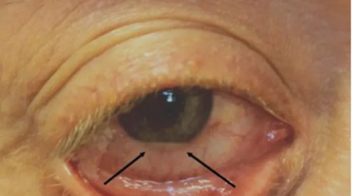Şekil 4. Ankilozan spondilitli bir hastada sağ gözde ön kamarada hipopiyon varlığı.   Özellikle  HLA-B27  pozitif  hastalarda  nadir  de  olsa  AAU’in  kronik  seyir  gösterdiği  ve  pupiller  oklüzyon,  görme  keskinliğinde  azalma,  katarakt,  sekonder  