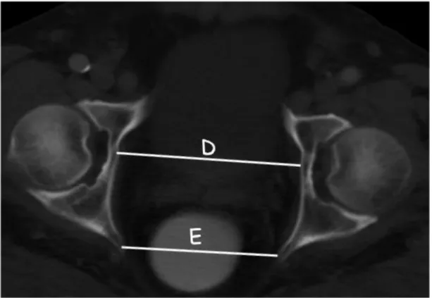 Şekil 3: (D) İnterfemorapelvik mesafe: Aksial kesitte femur başlarının merkesinden  geçen  hat  düzeyinde  kemik  pelvisin  içten  içe  genişliği