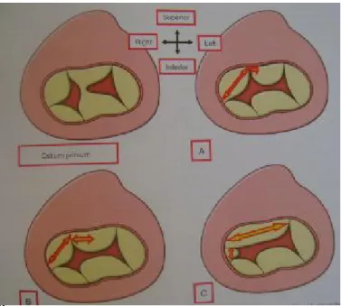 Şekil 13. Rastelli sınıflaması. Tip A’ da süperior bridging leaflet daha çok sol ventrikül  ile  ilişkili olup sağ  ventriküle doğru  ilerleme derecesine göre B veya  C olarak  isimlendirilir