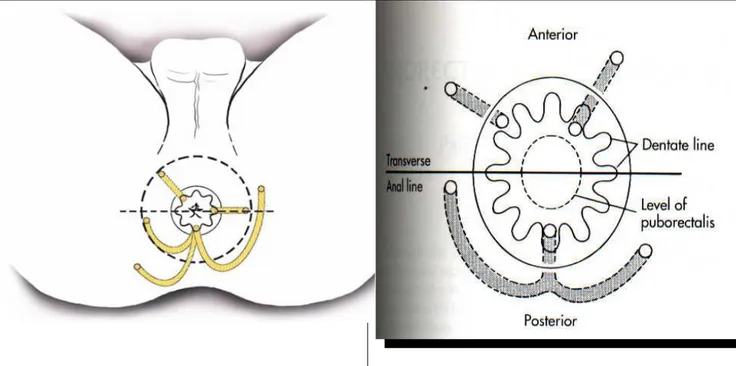 Şekil 6a: Goodsall - Sallmon kuralı (The ASCRS text book of colon and rectum surgery) 