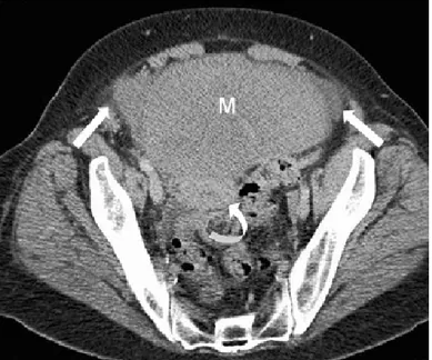 Şekil 8: 28 yaşında akut ağrı ile gelen hastanın koronal kesit BT görüntüsünde  spiral şeklinde dönmüş vasküler pedikül izlenmektedir