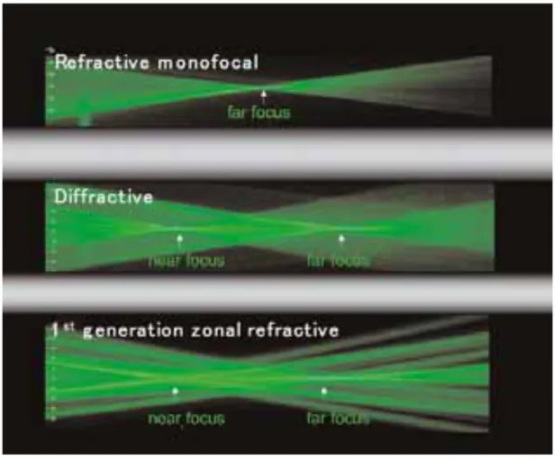 Şekil 6: Refraktif monofokal, difraktif ve refraktif MGİL’lerin oluşturdukları odaklar  Bu  merceklerle  yakın  ve  uzak  mesafeler  için  iki  farklı  odak  oluşturularak  hastanın  gözlük  takma  ihtiyacı  ortadan  kaldırmaya  çalışılmaktadır