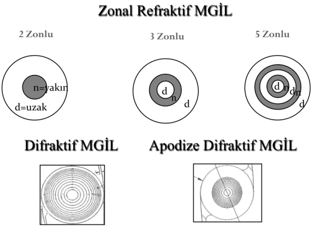 Şekil 7: Zonal refraktif, difraktif ve apodize difraktif MGİL’lerin şematik görünümü 