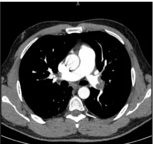 Şekil 3.   Bilateral ana pulmoner arterlerde saptanan trombüs 