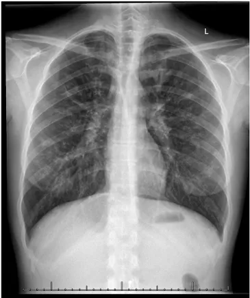 Şekil 1.    Kistik fibrozisli hastanın akciğer grafisi  