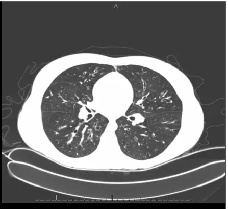 Şekil 2.    Kistik fibrozisli hastanın akciğer tomografisi  