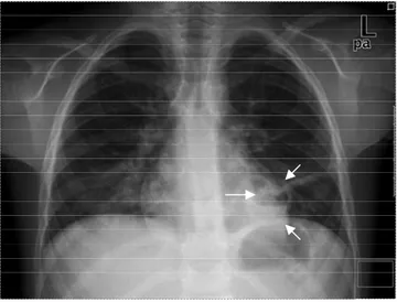 Figure 1.   Chest X-Ray of the patient. Air-fluid level in the left lung considers lung abscess (Lung abscess is marked with arrows) 