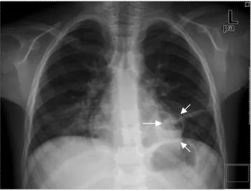 Figure 1.   Chest X-Ray of the patient. Air-fluid level in the left lung considers lung abscess (Lung abscess is marked with arrows) 