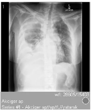 Figure 1.    Massive pleural effusion in right lung in the thoracal 