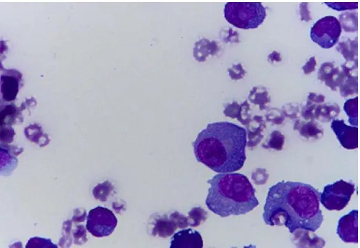 Figure 2.     In cytological evaluation of pleural effusion that plasma cell infiltration 
