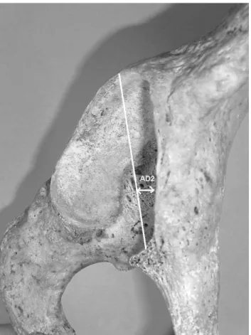 Figure 2.       The vertical distance between the deepest point of acetabular   cavity   and   the   horizontal   plane   touching   the acetabular edges (acetabular depth )(AD2)