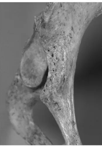 Figure 4.   Curved type of anterior acetabular ridge