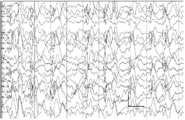 Şekil 1.   Elekroensefalografide hipsaritmi paterni