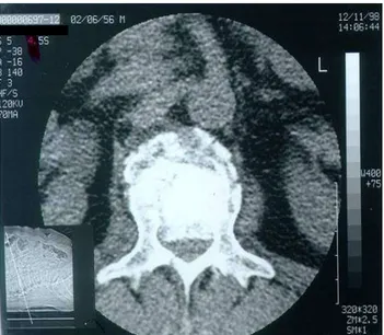 Tablo III.  Olguların preoperatif sınıflaması