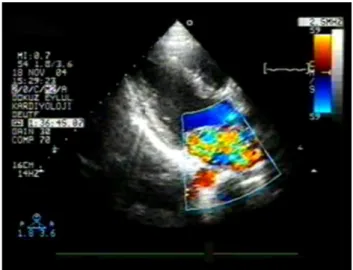 Şekil   1.  Mitral   kapakta   posterior   leafleti   tutan   kordal