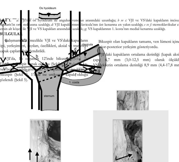 Şekil 1.      a:  VJI’nın  os hyoideum ile angulus venosus arasındaki uzunluğu;  b ve c:  VJI ve VS’daki kapakların incisura