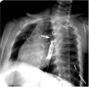 Şekil 1.     Baryumlu özefagus grafisinde özefagus anterior