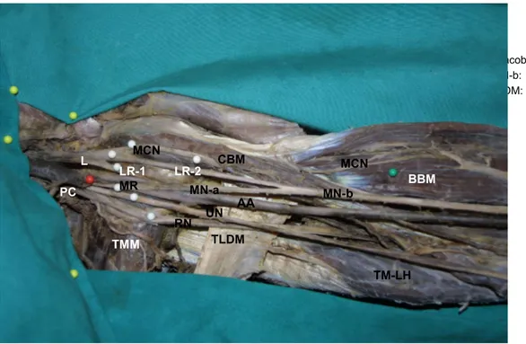 Figure   1.      LC:   Lateral   cord,   LR-1:   First   lateral   root,   LR-2:   Second   lateral   root,   CBM:   Coracobrachialis   muscle,   MCN: Musculocutaneous nevre, BBM: Biceps brachii muscle, MR: Medial root, MN-a: Median nerve-a part, MN-b: Med